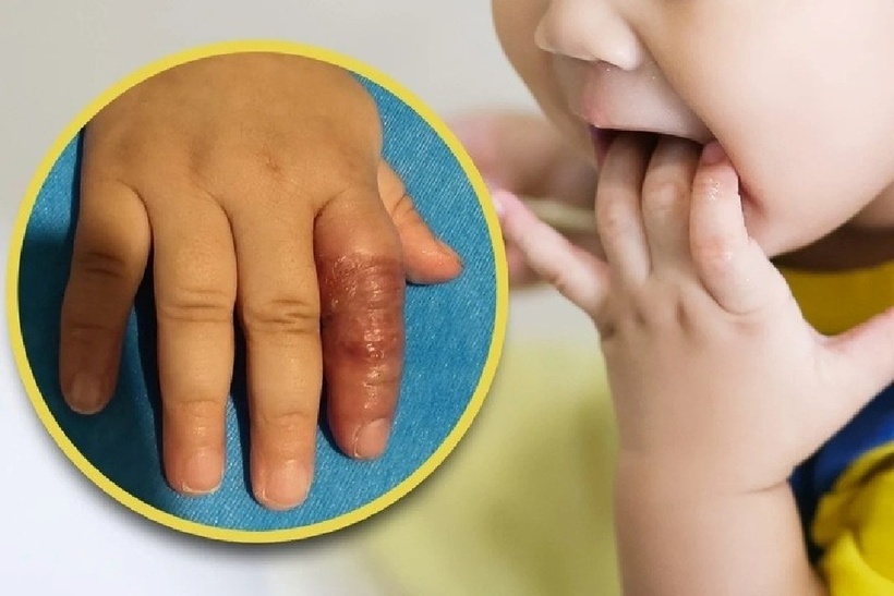 Ngón trỏ của cô bé bị sưng và tím do bị mẹ dùng băng quấn lại. Ảnh: Sina.