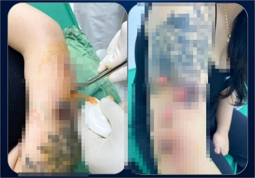 Chị T. đã phải gánh chịu biến chứng nghiêm trọng sau khi tiêm botox thon gọn bắp tay tại một cơ sở kém uy tín. Ảnh: Sức khỏe & Đời sống.