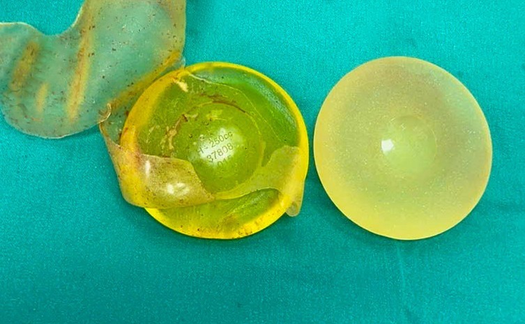 Túi ngực sau phẫu thuật tháo bỏ. Ảnh: BVCC