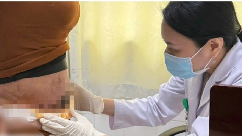 Vùng bụng bị biến chứng hoại tử da sau hút mỡ bụng của bệnh nhân. Ảnh: Báo Lao động.