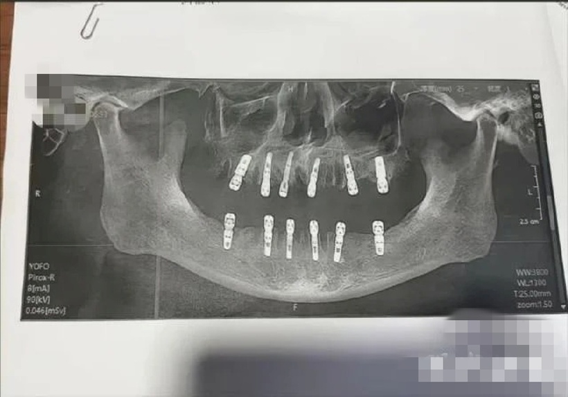 Cụ ông 77 tuổi tử vong sau cấy 6 implant và nhổ 12 răng. Ảnh minh họa.