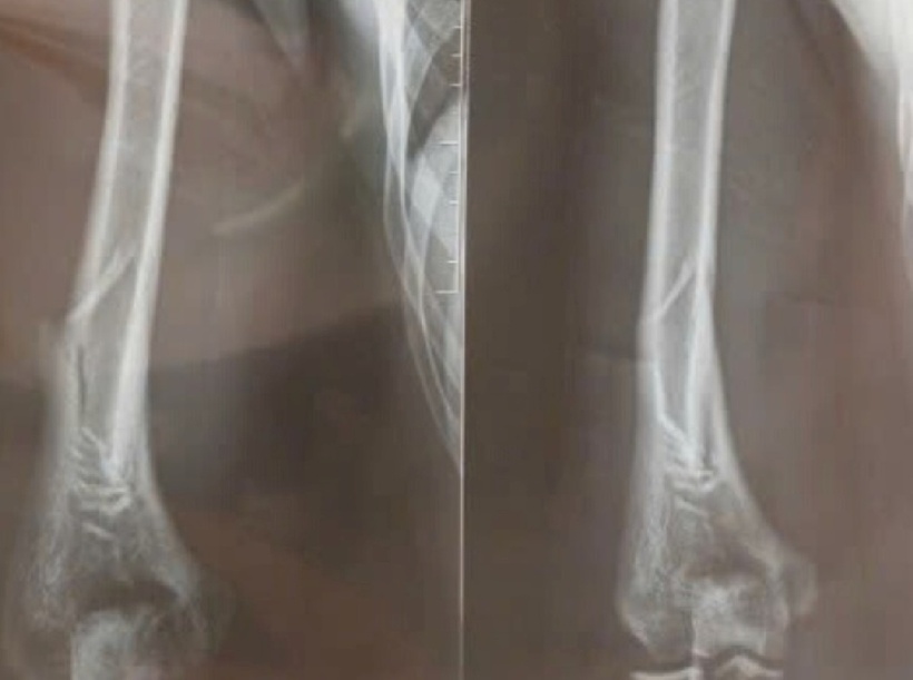 Ảnh chụp X-quang cánh tay phải của bệnh nhân. Ảnh: Báo Tuổi trẻ.