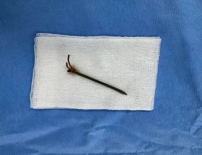 Chiếc đinh sắt cắm sâu vào giữa cổ bệnh nhân. Ảnh: PLO.