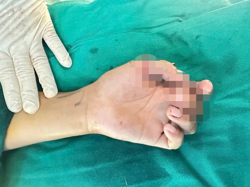 Sau hơn 6 tiếng đồng hồ tỉ mỉ khâu nối vi mạch, thần kinh và cố định xương, các bác sĩ đã giữ được cả hai ngón tay cho bệnh nhi. Ảnh: PLO.