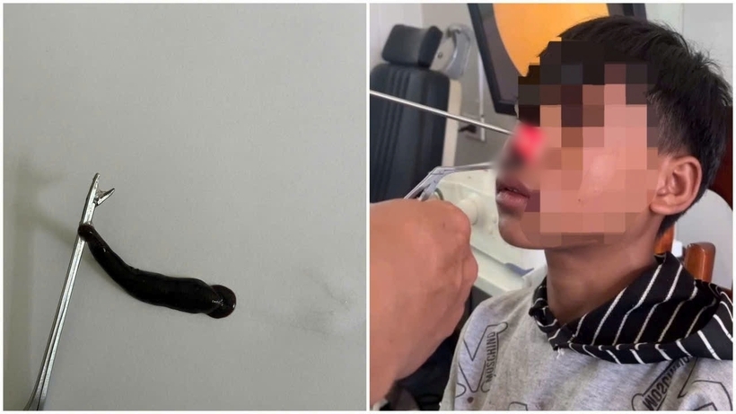 Bác sĩ tiến hành thủ thuật nội soi mũi gắp ra một con đỉa dài khoảng 4cm. Ảnh: VietNamNet