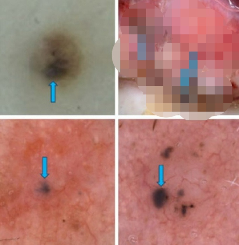 Hình ảnh ung thư tế bào đáy. Ảnh: Sức khỏe & Đời sống.