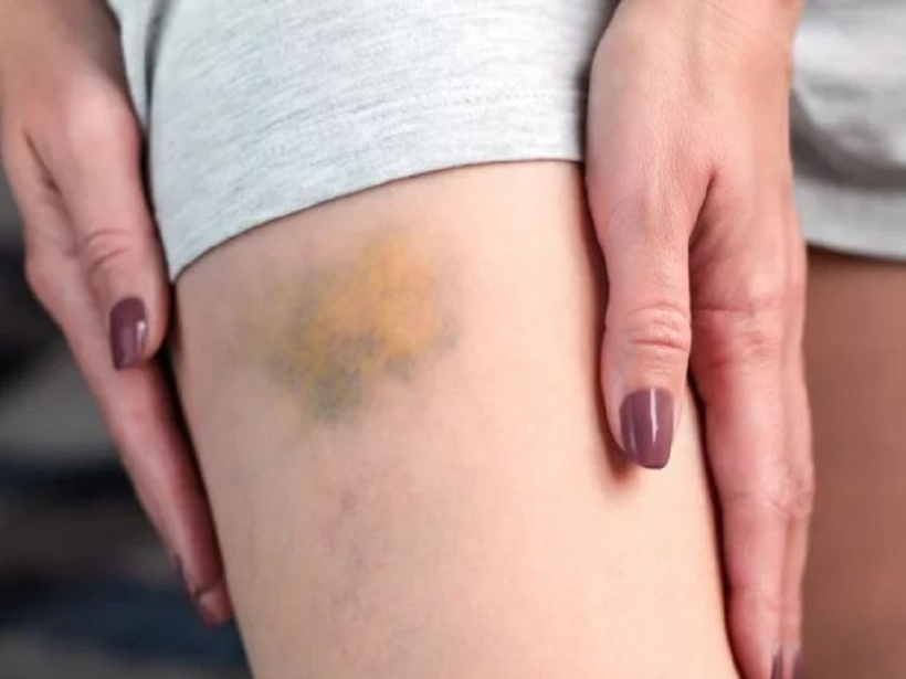 6 bất thường về ngoại hình cảnh báo gan đã quá tải - 2