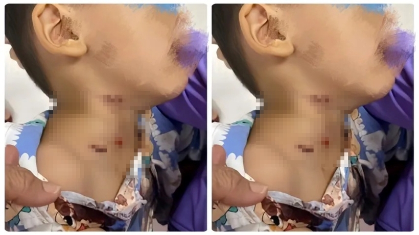 Bé trai bị nhiều vết thương do chó cắn ở vùng cổ, gáy. Ảnh: Pháp Luật TP.HCM