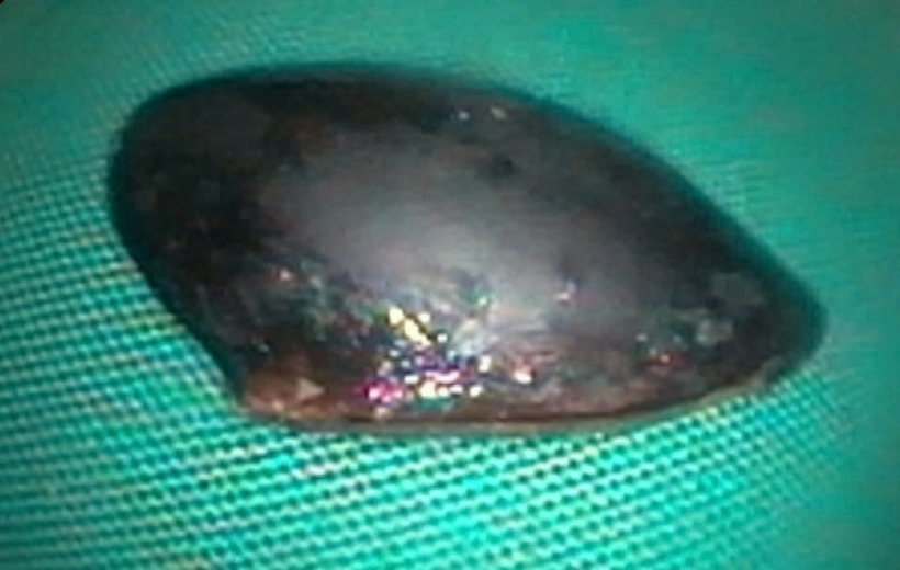 Dị vật là một hạt trái cây màu đen, trơn nhẵn. Ảnh: Thanh Niên