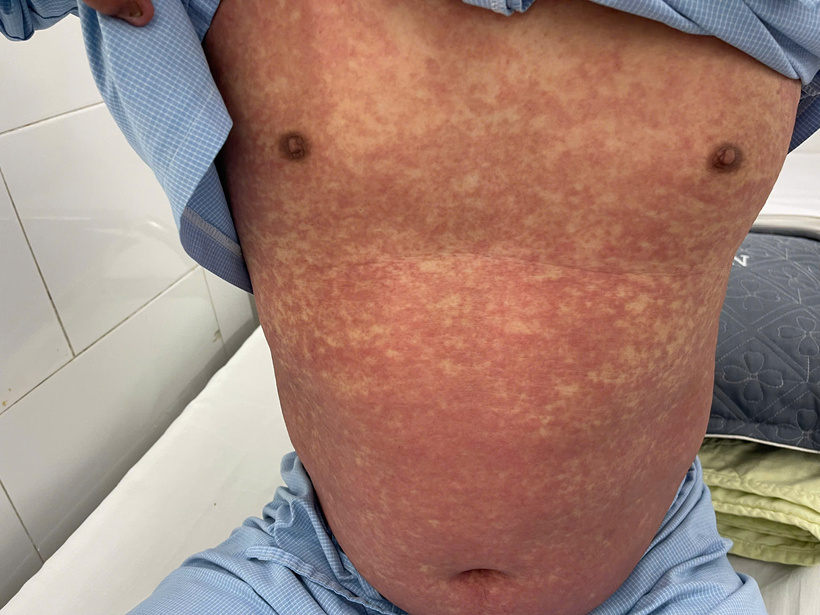 Hình ảnh phát ban toàn thân trên bệnh nhân dị ứng thuốc nặng do Phenylbutazone