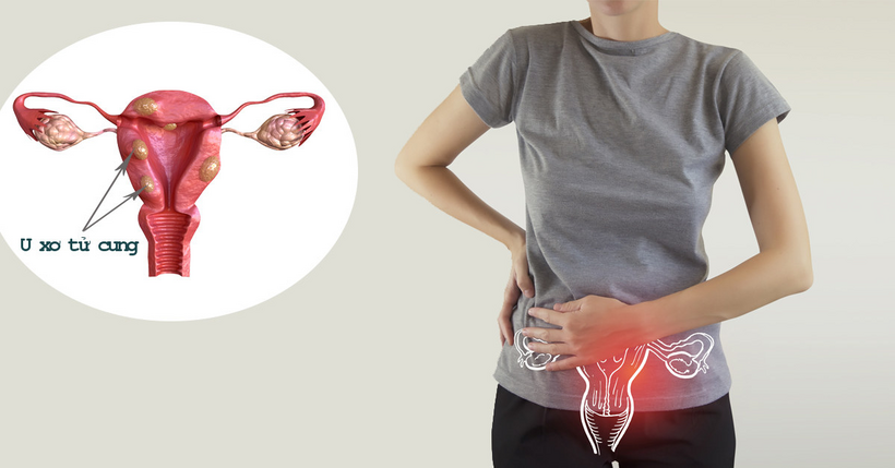U xơ tử cung có thể gây đau bụng, rối loạn kinh nguyệt