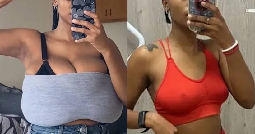 Cô gái trước và sau khi phẫu thuật thu nhỏ ngực. Ảnh: NYP