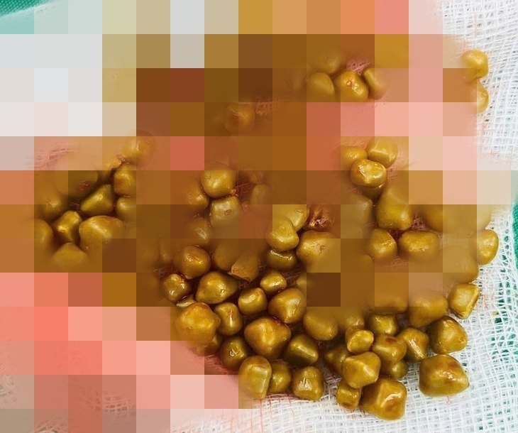 Hơn 100 viên sỏi màu vàng đồng được lấy ra từ túi mật của bệnh nhân. Ảnh: Dân Trí.