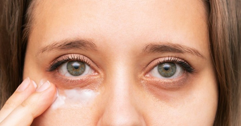 Quầng thâm mắt không chỉ đơn thuần là biểu hiện của sự mệt mỏi, mà còn có thể là lời cảnh báo từ bệnh thận.