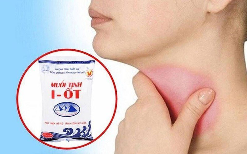Thiếu i-ốt là nguyên nhân chính gây bướu cổ