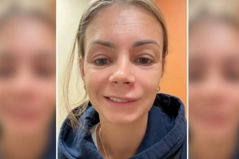 Lish Marie phải đến phòng cấp cứu sau khi dùng móng tay nặn mụn bên dưới lỗ mũi trái. Ảnh: NYP