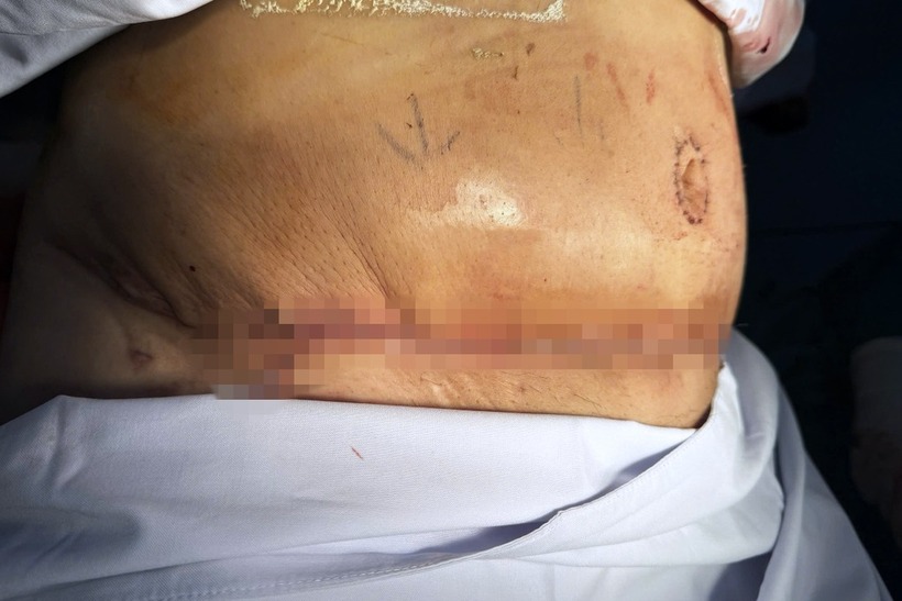 Những vết sẹo dài sau khi hút mỡ bụng. Ảnh: Dân Trí.