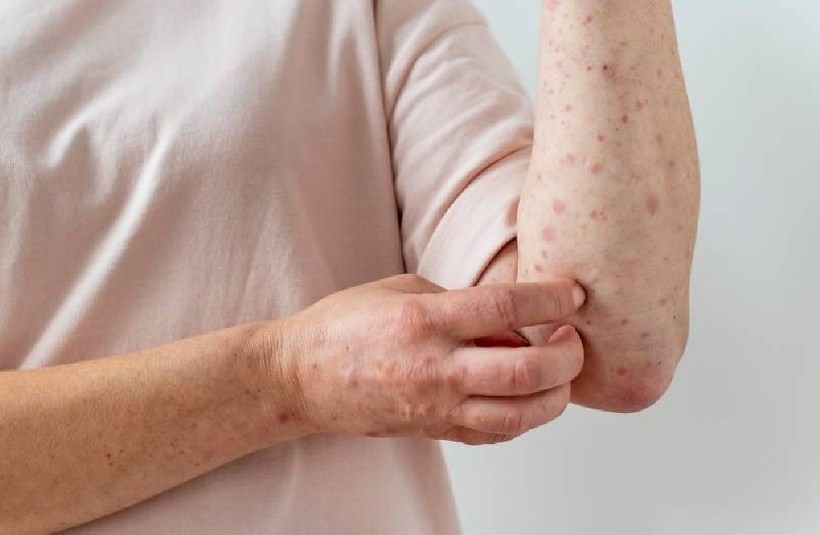 Khi thận không thể loại bỏ chất thải ra khỏi cơ thể, tình trạng phát ban có thể phát triển.