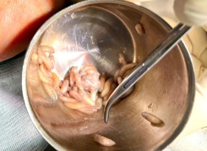 Bác sĩ gắp được hơn 100 con giòi từ vết thương hở vòm miệng của người bệnh. Ảnh: Dân trí