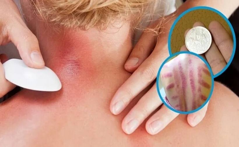 Cạo gió hay đánh gió mang lại hiệu quả khi giúp cơ thể thoải mái hơn. (Ảnh minh họa)