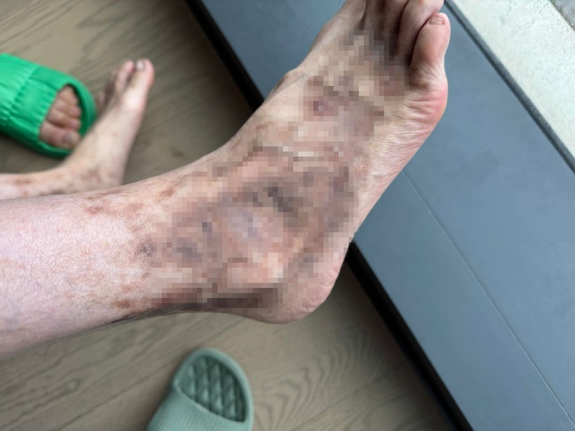 Hình ảnh của một tiktoker chia sẻ thời gian gần đây rằng, bản thân người này bị mắc viêm mao mạch khiến sinh hoạt và cuộc sống bị ảnh hưởng