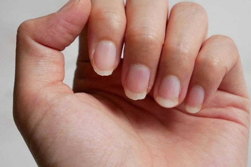 Nếu móng tay út nhợt nhạt, có đốm trắng hoặc khô, không bóng, chức năng thận nguy cơ có vấn đề.