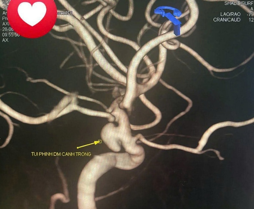 Hình ảnh túi phình động mạch cảnh. Ảnh: Vnexpress.