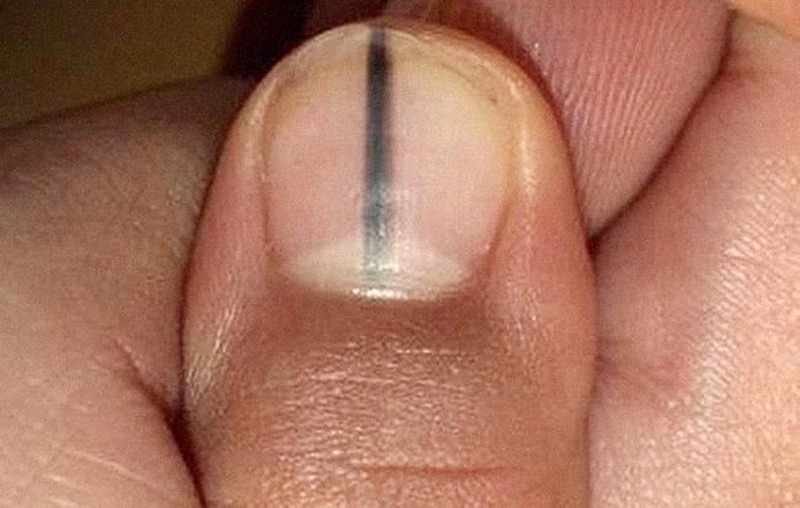 Móng tay xuất hiện sọc đen có phải ung thư da không là một câu hỏi rất thường gặp