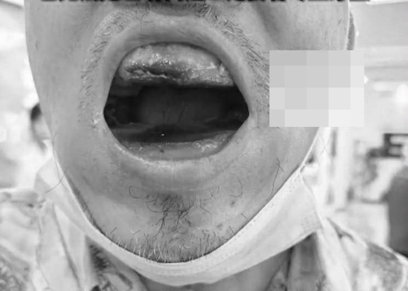 Hàm răng của người đàn ông. Ảnh: See Hua Daily News