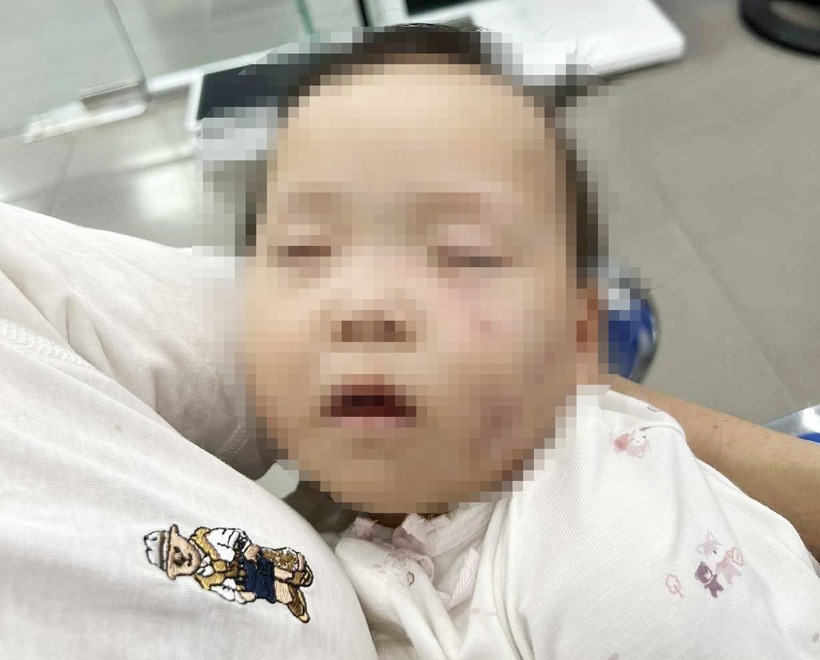 Hình ảnh cháu V với nhiều vết bầm tím trên mặt. (Ảnh: Tiền phong)