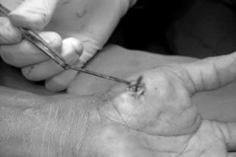 Bác sĩ lấy dị vật khỏi tay bệnh nhân. Ảnh: Dân Trí.