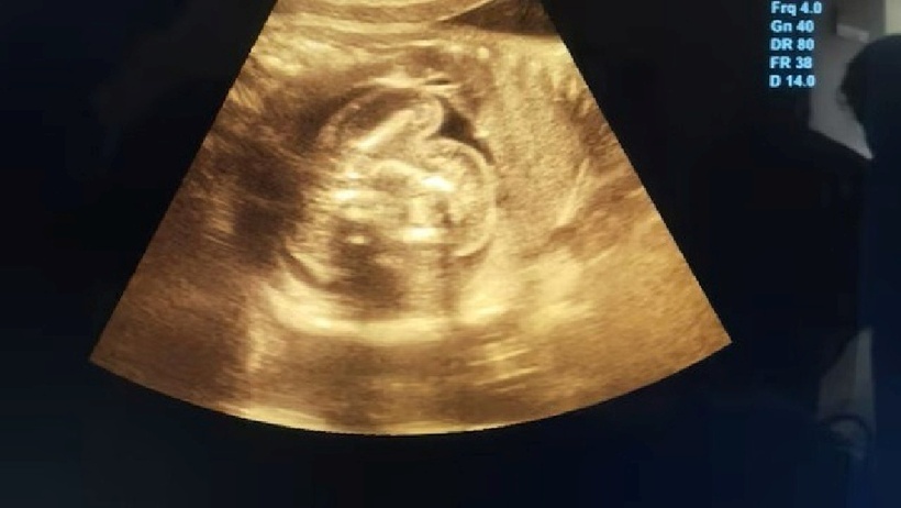 Bên trong bụng bé là 2 bào thai chưa phát triển, nằm gọn trong 1 túi duy nhất. Ảnh: India Today.