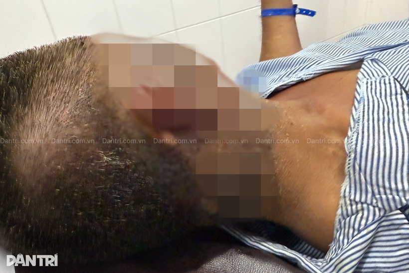 Vết bỏng ở mặt nạn nhân. Ảnh: Dân Trí.