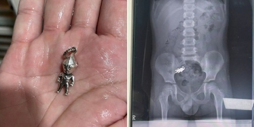 Cậu bé vô tình nuốt phải móc chìa khóa Ultraman trong lúc đang nhai bánh quy và xem TV. Ảnh: Người đưa tin.