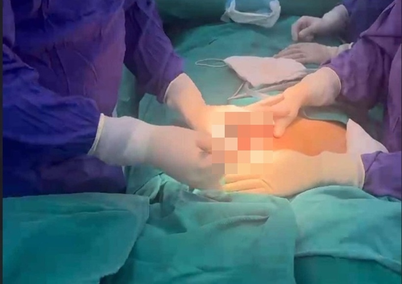 Các bác sĩ phẫu thuật chích rạch tháo mủ ổ áp xe, nạo hút dịch viêm, silicon, đồng thời bảo tồn nhu mô tuyến và quầng núm vú. Ảnh: Báo Người lao động.