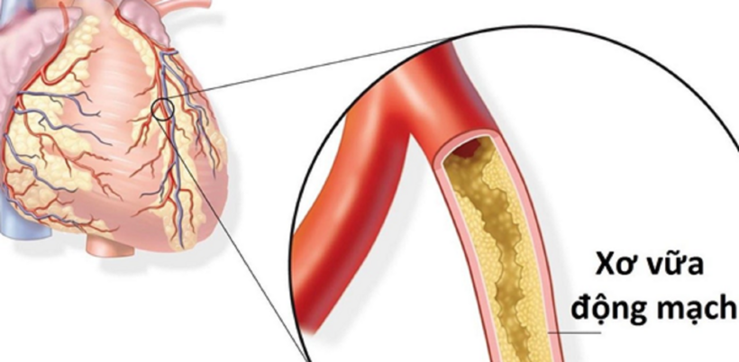Xơ vữa động mạch là một trong những nguyên nhân chính dẫn đến đau thắt ngực do tắc mạch