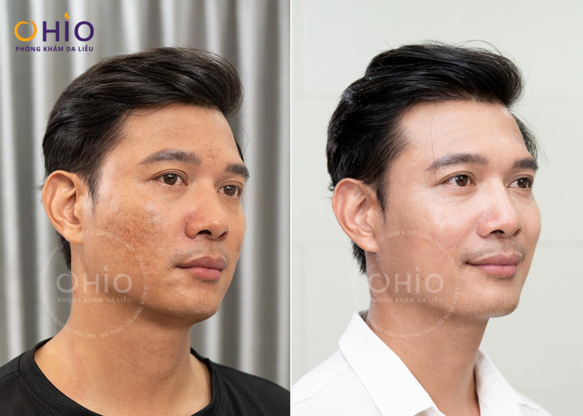 Khách hàng - Điều trị sẹo rỗ tại OHIO