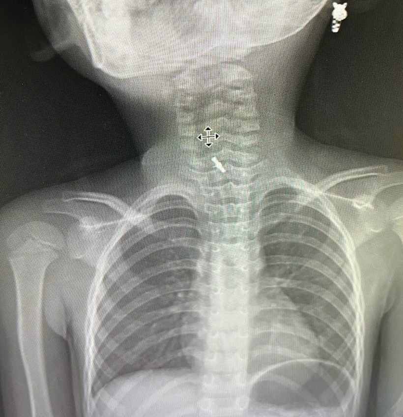 Hình ảnh chụp phim X-quang cho thấy bệnh nhi có dị vật mắc sâu trong thực quản. Ảnh: Báo Dân trí.