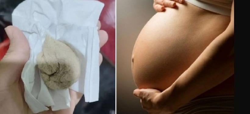 Người phụ nữ sốc nặng khi phát hiện một miếng gạc rơi ra trong cơ thể. Ảnh: Người đưa tin.