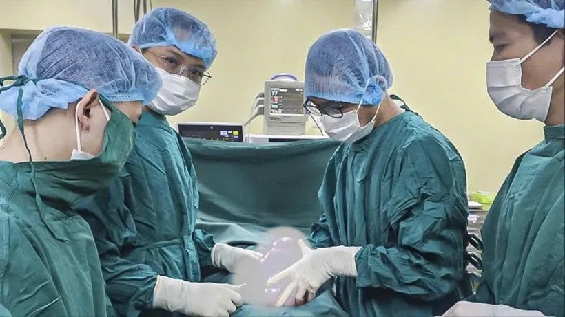 Khối u buồng trứng kích thước lớn được lấy ra từ bụng bệnh nhân. Ảnh: PLO
