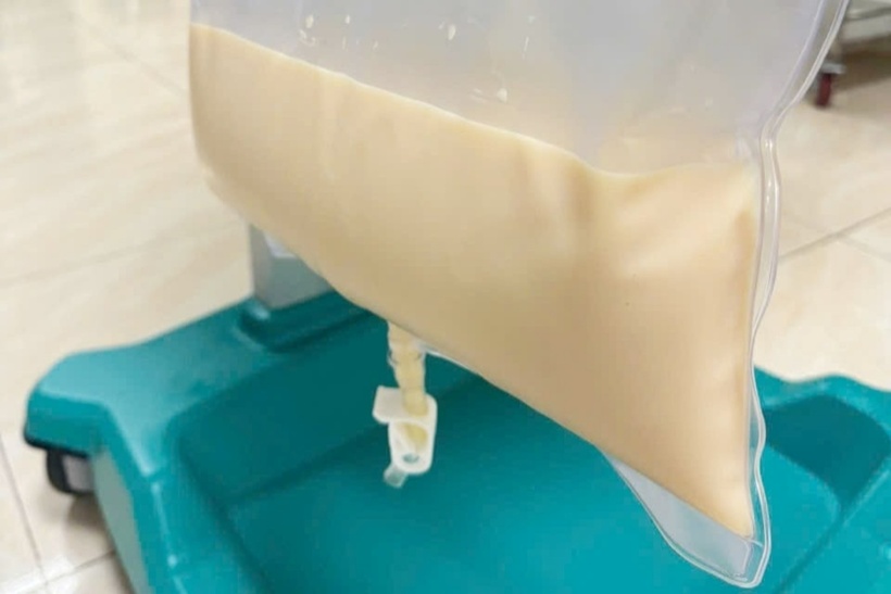 Thời điểm nhập viện huyết tương người bệnh trắng đục như sữa. Ảnh: Tạp chí Tri Thức.