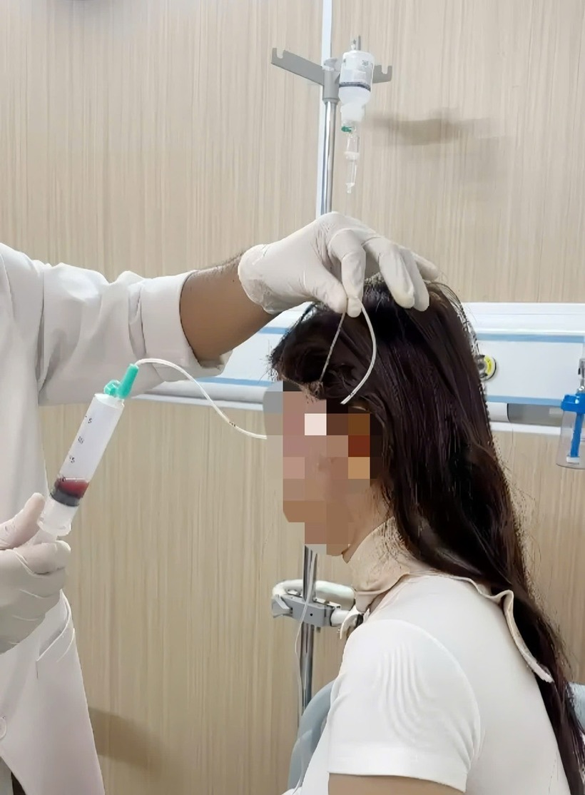 Bác sĩ đã hút ra một lượng lớn dịch, máu và filler từ mặt người phụ nữ.  Ảnh: Người Lao Động