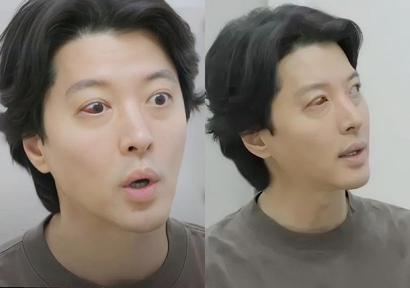 Một bên mắt của diễn viên Lee Dong Gun đã bị sưng và đỏ ngầu. Ảnh: SBS