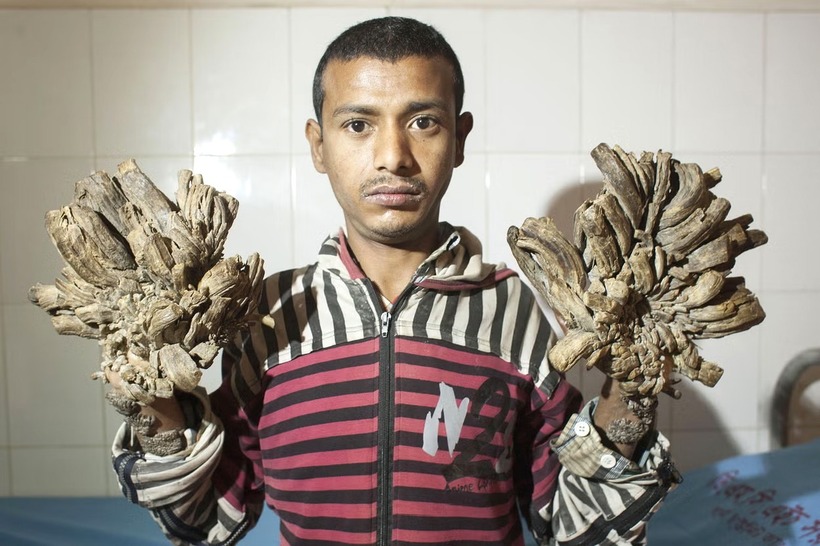 Abul Bajandar, 37 tuổi, được mệnh danh là "người cây" của Bangladesh. Ảnh: Independent.