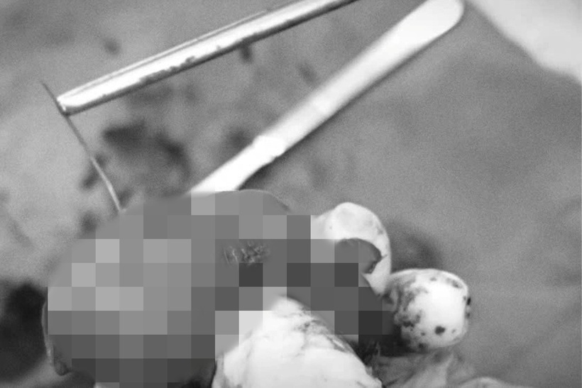 Xương cá đâm thủng ruột non. Ảnh: Dân Trí.