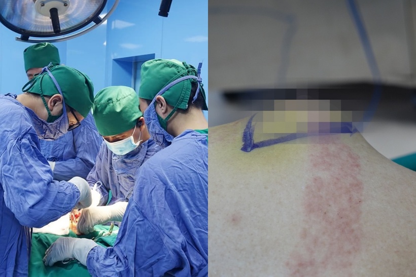 Cụ ông 86 tuổi bị ung thư vú, bệnh lý hiếm gặp chỉ 1/1000 độ ác tính ở nam giới. Ảnh: BVCC