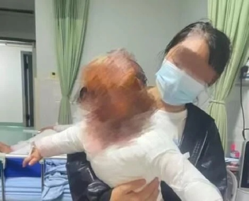 Hiện bé đã phải phẫu thuật cấp cứu, hiện vẫn cần điều trị lâu dài và ghép da để phục hồi. Ảnh: QQ.