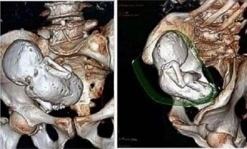 Chụp CT cho cụ bà 73 tuổi, bác sĩ "sốc nặng" vì phát hiện thai nhi hóa đá 30 năm. Ảnh: Người đưa tin.
