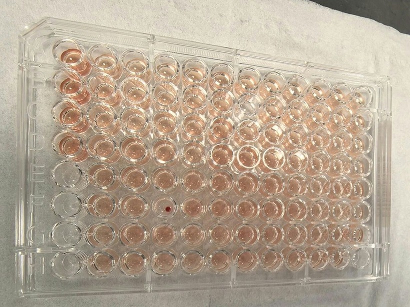 Nhóm máu Jk( a-b-) , được mệnh danh là “máu kim cương” vì mức độ cực kỳ hiếm gặp. Ảnh: Guangzhou Daily.