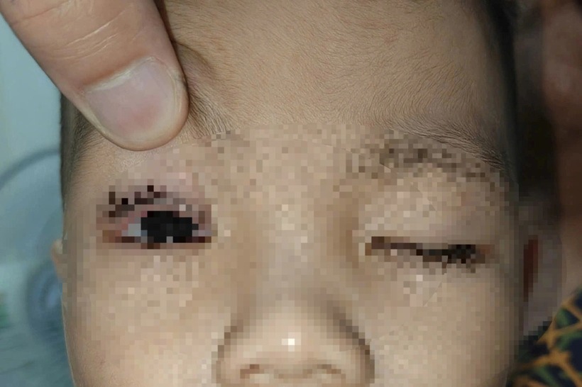 Các bác sĩ đã cứu chữa kịp thời cho cháu bé không may bị pháo hoa bắn trúng. Ảnh: Dân Trí.